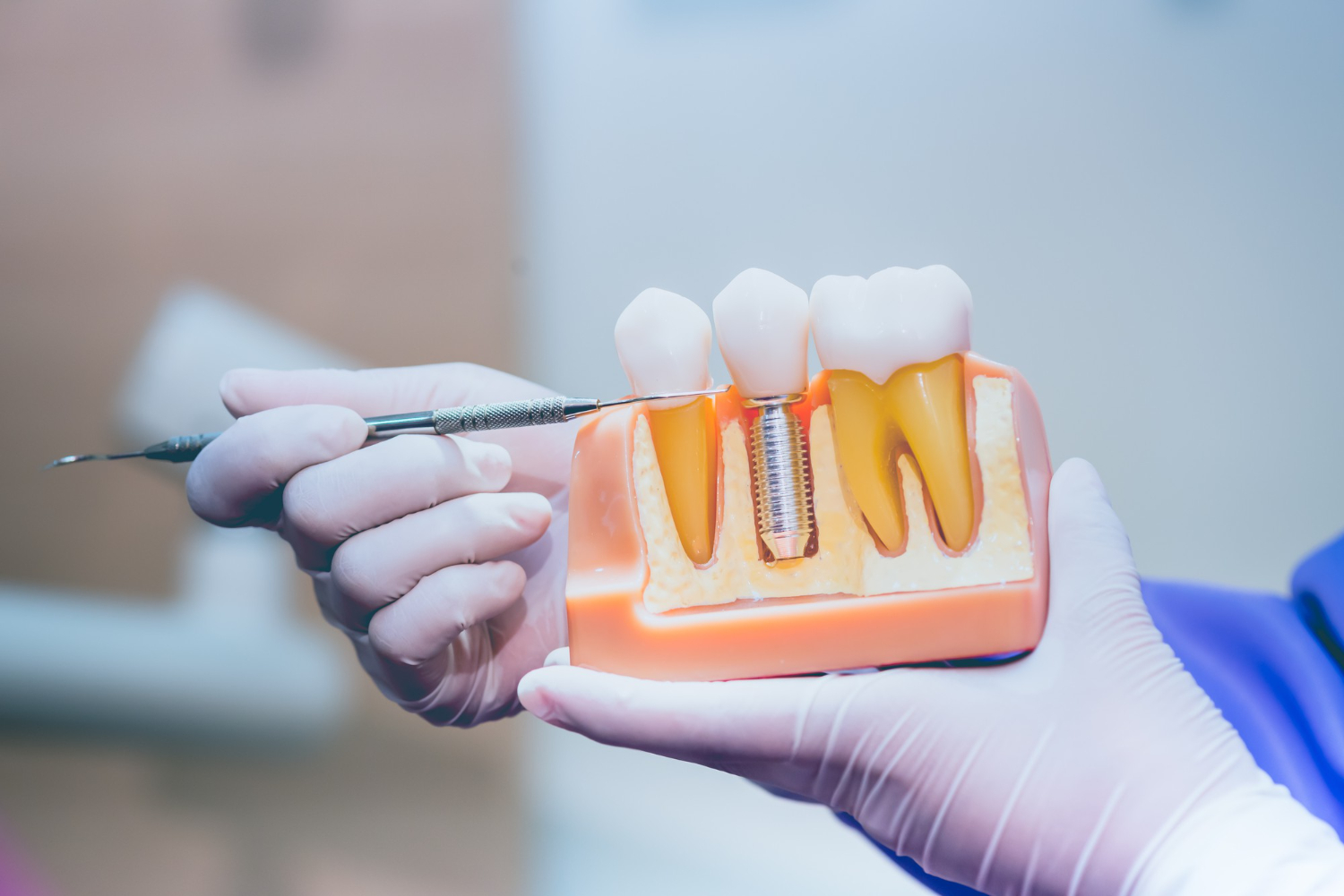 Implanty dentystyczne jako nowoczesna i trwała metoda odbudowy braków zębowych