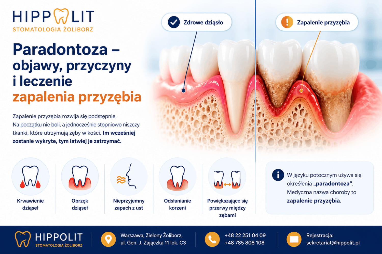 Co to jest paradontoza? Jakie daje objawy i jak wygląda leczenie zapalenia przyzębia?