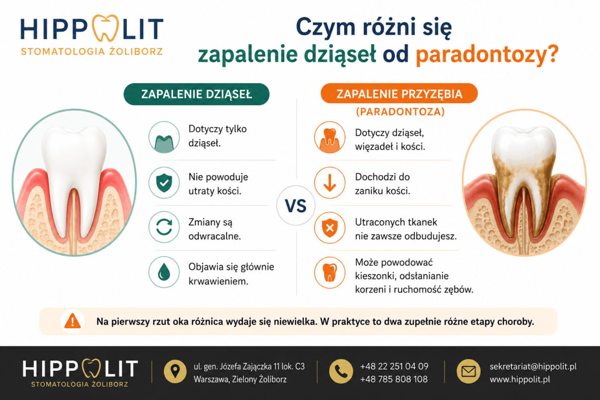 Czym różni się zapalenie dziąseł od paradontozy Czym różni się zapalenie dziąseł od paradontozy
