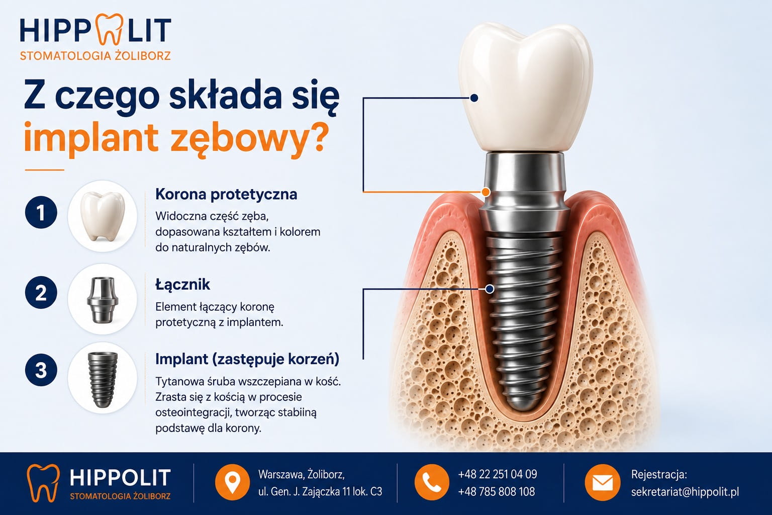 Z czego składa się implant zębowy Z czego składa się implant zębowy