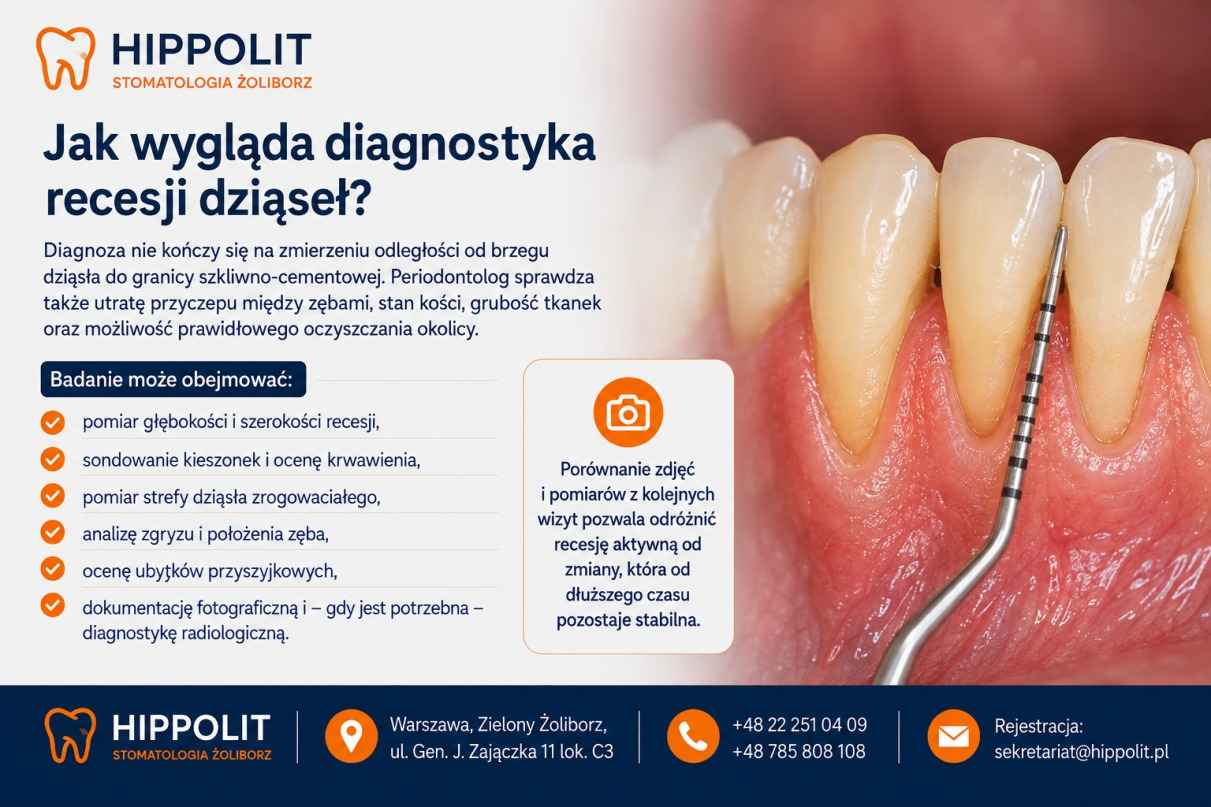 Cofanie się dziąsła z odsłonięciem korzenia zęba Widoczne cofanie się dziąsła i odsłonięta powierzchnia korzenia zęba